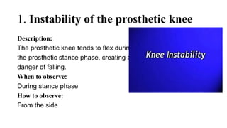 1. Instability of the prosthetic knee
Description:
The prosthetic knee tends to flex during
the prosthetic stance phase, creating a
danger of falling.
When to observe:
During stance phase
How to observe:
From the side
 