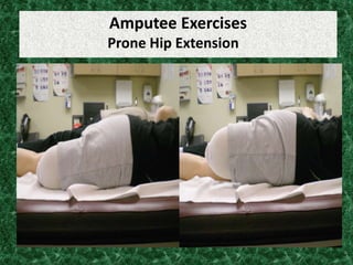 Amputee Exercises
Prone Hip Extension
 