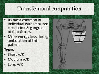 Transfemoral Amputation
• Its most common in
individual with impaired
circulation & gangrene
of foot & toes
• More energy loss during
ambulation of this
patient
Types
• Short A/K
• Medium A/K
• Long A/K
 