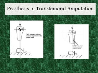 Prosthesis in Transfemoral Amputation
 