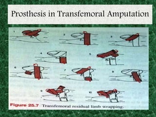 Prosthesis in Transfemoral Amputation
 