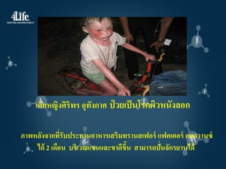 เด็กหญิงศิริพร อุทงกาศ ป่ วยเป็ นโรคผิวหนังลอก
                      ั

ภาพหลังจากทีรับประทานอาหารเสริมทรานสเฟอร์ แฟคเตอร์ แอดวานซ์
              ่
    ได้ 2 เดือน บริเวณแขนและขาดีขน สามารถปั่นจักรยานได้
                                 ึ้
 