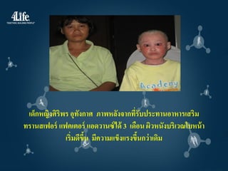 เด็กหญิงศิริพร อุทงกาศ ภาพหลังจากทีรับประทานอาหารเสริม
                    ั                 ่
ทรานสเฟอร์ แฟคเตอร์ แอดวานซ์ ได้ 3 เดือน ผิวหนังบริเวณใบหน้ า
              เริ่มดีขน มีความแข็งแรงขึนกว่ าเดิม
                      ึ้                ้
 