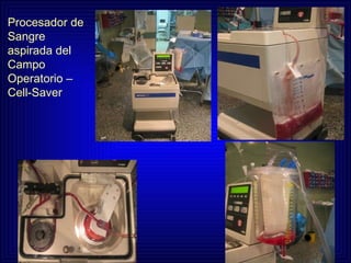 Procesador de Sangre aspirada del Campo Operatorio –Cell-Saver 