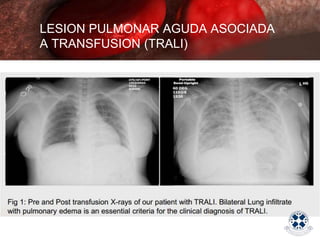 LESION PULMONAR AGUDA ASOCIADA
A TRANSFUSION (TRALI)
 
