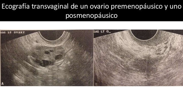 transicion-a-la-menopausia-menopausia-posmenopausia