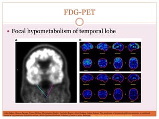 FDG-PET
 Focal hypometabolism of temporal lobe
John Baker, Sharon Savage, Fraser Milton, Christopher Butler, Narinder Kapur, John Hodges, Adam Zeman, The syndrome of transient epileptic amnesia: a combined
series of 115 cases and literature review, Brain Communications, Volume 3, Issue 2, 2021, fcab038, https://doi.org/10.1093/braincomms/fcab038
 