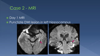  Day 1 MRI
 Punctate DWI lesion in left hippocampus
 