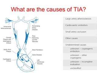 What are the causes of TIA?
 