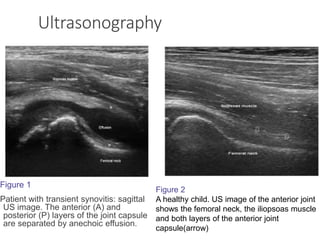 Ultrasonography
Figure 1
Patient with transient synovitis: sagittal
US image. The anterior (A) and
posterior (P) layers of the joint capsule
are separated by anechoic effusion.
Figure 2
A healthy child. US image of the anterior joint
shows the femoral neck, the iliopsoas muscle
and both layers of the anterior joint
capsule(arrow)
 