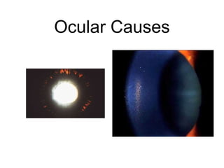 Ocular Causes
 