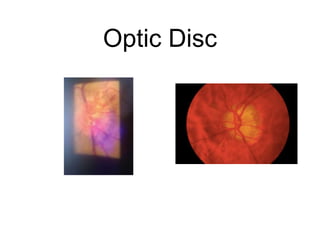 Optic Disc
 