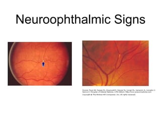 Neuroophthalmic Signs
 