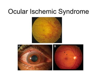 Ocular Ischemic Syndrome
 