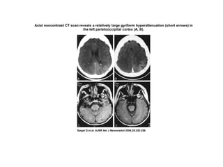 Axial noncontrast CT scan reveals a relatively large gyriform hyperattenuation (short arrows) in
the left parietooccipital cortex (A, B).
Saigal G et al. AJNR Am J Neuroradiol 2004;25:252-256
 