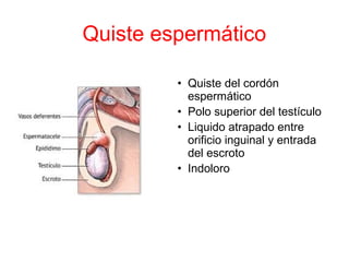 Quiste espermático
• Quiste del cordón
espermático
• Polo superior del testículo
• Liquido atrapado entre
orificio inguinal y entrada
del escroto
• Indoloro
 