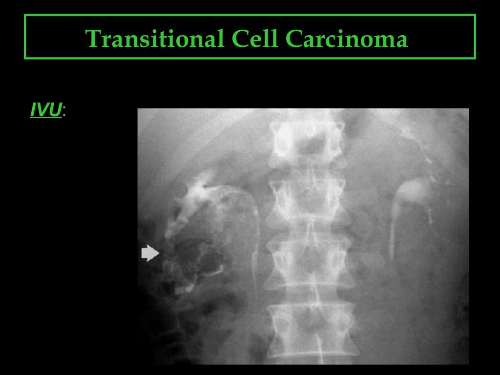 Transitional cell carcinoma