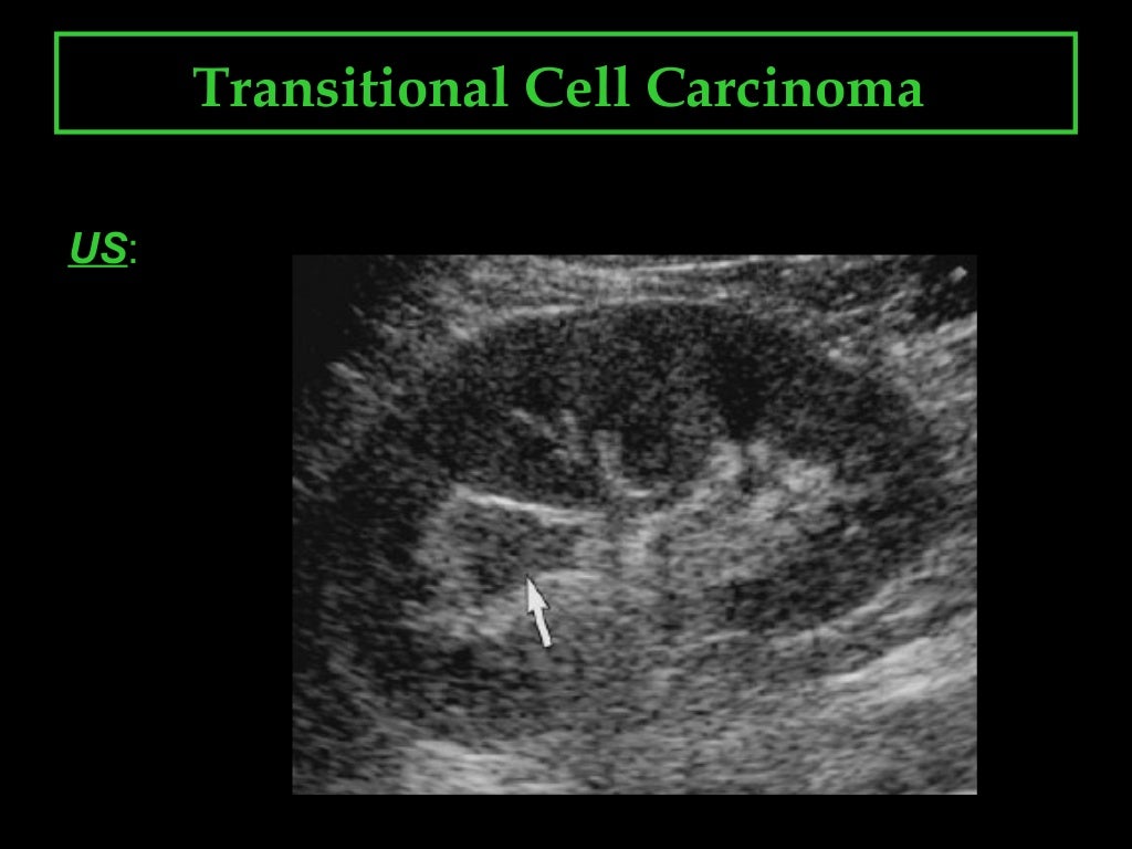 Transitional cell carcinoma