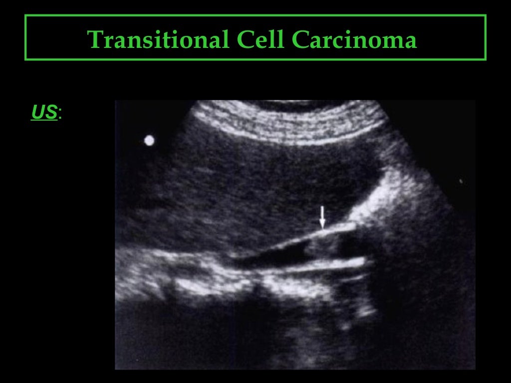 Transitional cell carcinoma