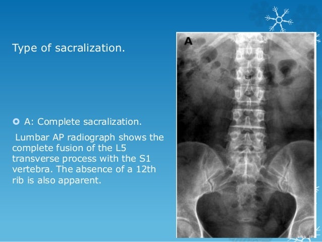 Transitional vertebrae
