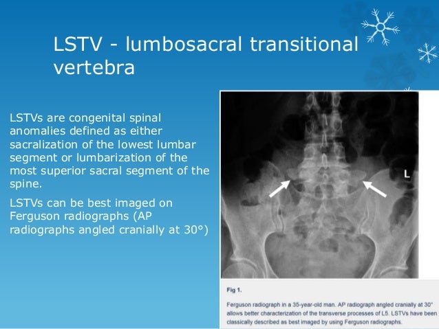 Transitional vertebrae radiology