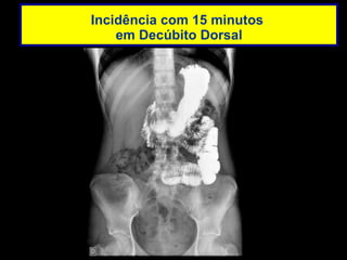 Incidência com 15 minutos  em Decúbito Dorsal 