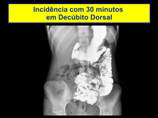 Incidência com 30 minutos  em Decúbito Dorsal 