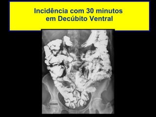 Incidência com 30 minutos  em Decúbito Ventral 