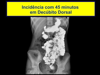 Incidência com 45 minutos  em Decúbito Dorsal 