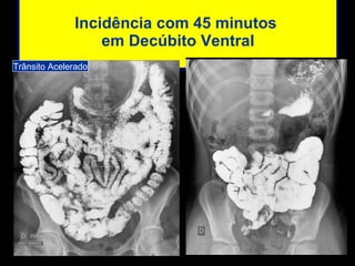 Incidência com 45 minutos  em Decúbito Ventral Trânsito Acelerado 