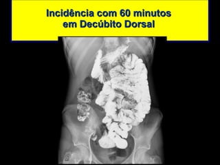 Incidência com 60 minutos  em Decúbito Dorsal  
