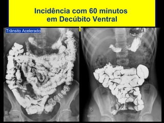 Incidência com 60 minutos  em Decúbito Ventral Trânsito Acelerado 
