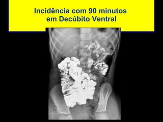 Incidência com 90 minutos  em Decúbito Ventral 