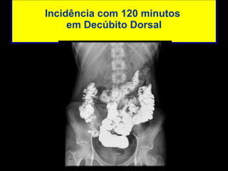 Incidência com 120 minutos  em Decúbito Dorsal 