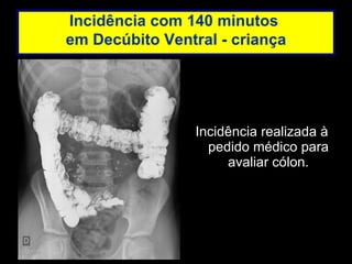 Incidência realizada à pedido médico para avaliar cólon. Incidência com 140 minutos  em Decúbito Ventral - criança 