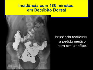 Incidência com 180 minutos  em Decúbito Dorsal Incidência realizada à pedido médico para avaliar cólon. 
