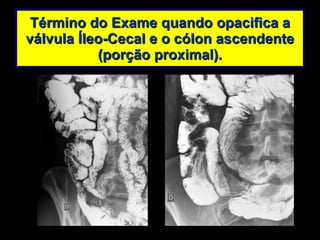 Término do Exame quando opacifica a válvula Íleo-Cecal e o cólon ascendente (porção proximal). 