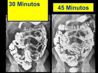 30 Minutos    45 Minutos  