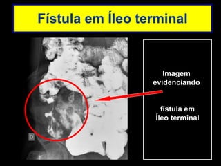 Fístula em Íleo terminal Imagem  evidenciando  fístula em Íleo terminal 