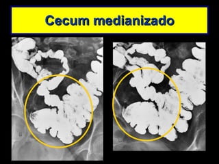 Cecum medianizado 