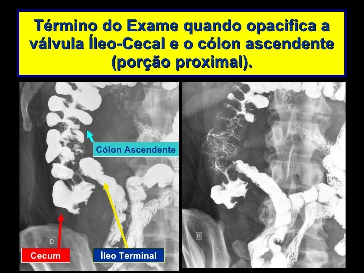 Transito intestinal exame