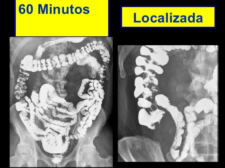 Transito intestinal exame