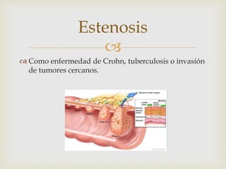 
 Como enfermedad de Crohn, tuberculosis o invasión
de tumores cercanos.
Estenosis
 