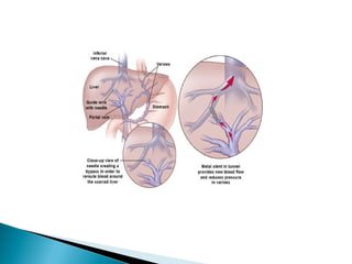 Tips Procedure Entry Transjugular intrahepatic porto systemic shunt | PPT