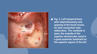 ● Fig. 2. Left temporal bone
after labyrinthectomy and
opening of the facial recess
for later eustachian tube
obliteration. The vestibule is
open; the ampulla of the
superior semicircular canal is
a good anatomic landmark for
the superior aspect of the IAC
 