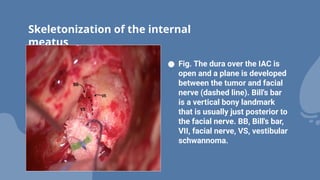 Skeletonization of the internal
meatus
● Fig. The dura over the IAC is
open and a plane is developed
between the tumor and facial
nerve (dashed line). Bill's bar
is a vertical bony landmark
that is usually just posterior to
the facial nerve. BB, Bill's bar,
VII, facial nerve, VS, vestibular
schwannoma.
 
