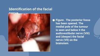 Identification of the facial
nerve
● Figure . The posterior fossa
has been opened. The
medial pole of the tumour
is seen and below it the
audiovestibular nerve (VIII)
and (deeper) the facial
nerve (VII) on the
brainstem.
 