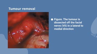 Tumour removal
● Figure. The tumour is
dissected off the facial
nerve (VII) in a lateral to
medial direction
 