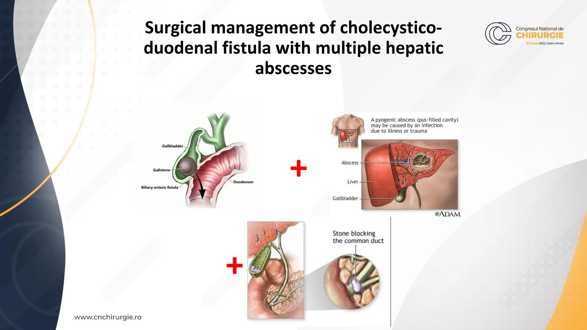 CHOLEDOCHOLITHIASIS WITH CHOLECYSTODUODENAL FISTULA AND MULTIPLE LIVER ...