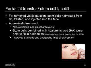 Facial fat transfer / stem cell facelift Fat removed via liposuction, stem cells harvested from fat, treated, and injected into the face Anti-wrinkle treatment Nasolabial fold and glabellar furrows Stem cells combined with hyaluronic acid (HA) were able to fill in deep folds  (Claudio-da-Silva C et al, Rev Col Bras Cir, 2009) Improved skin tone and decreasing lines of expression Image credit: http://www.thebeautyrules.com 
